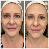 Before and After One Microcurrent Treatment